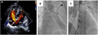Case report: Amplatzer septal occluder device migration into the descending thoracic aortic isthmus: percutaneous retrieval and redeployment